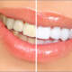 Teeth Whitening